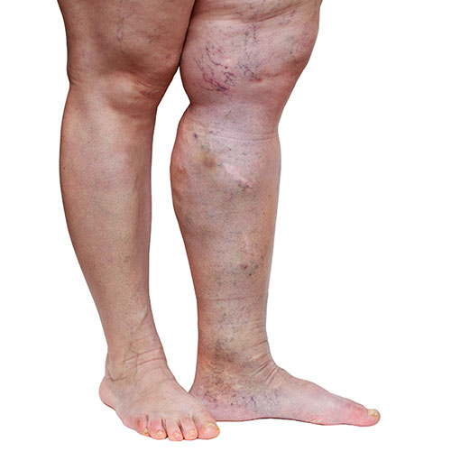 Person with edema in one legPerson with edema in one leg