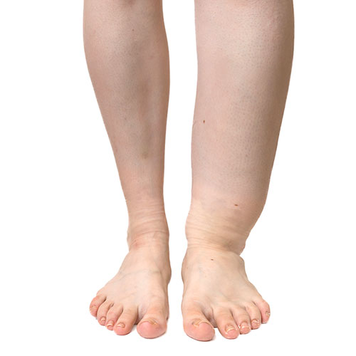 Person with lower leg swelling