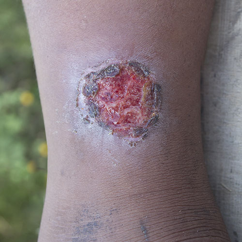 Leg with a Venous Leg Ulcer (VLU)