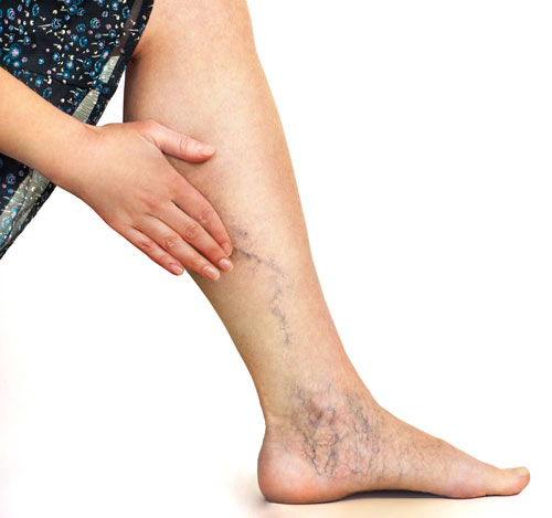 Chronic Venous Insufficiency and Lymphedema - Lymphedema Therapy